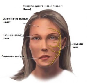 Можно ли курить при невралгии лицевого нерва?