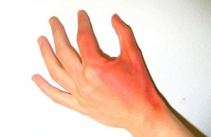 Почему ожог углубляется, если его не охладить?