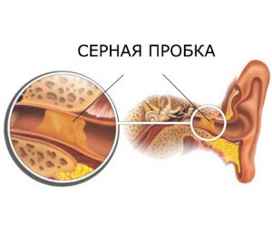 Как понять есть ли пробки в ушах?