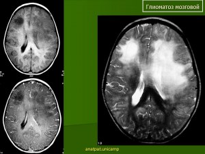 Что такое глиоматоз?