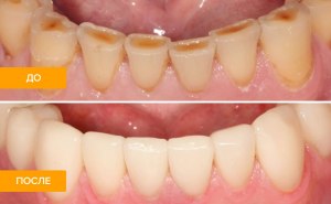 Должен ли стоматолог давать гарантии на зубные циркониевые коронки?