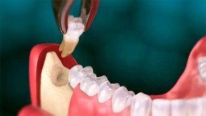 Можно ли удалять зубы в летний период?