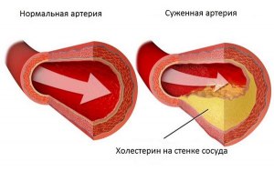 Почему при диабете ампутируют конечности?