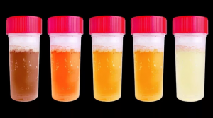 Что означает очень темная моча у человека?