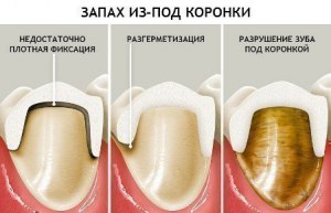 Отчего иногда сильно гниют и разрушаются зубы под коронками?