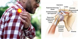 Что делать с проблемами в плече?