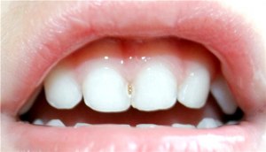 Может ли перейти кариес с молочных зубов на постоянные?