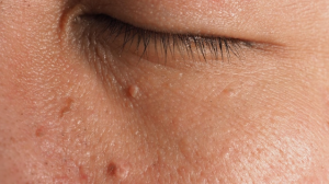 Если содрать папиллому, она вырастет вновь?