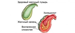 Какой размер камней является критичным при холецистите?