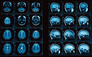 Что происходит с мозгом при рассеянном склерозе?