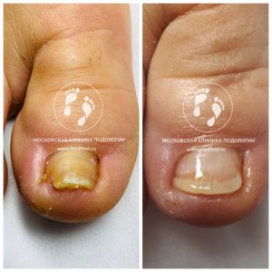 Как лечить неровные ногтевые пластины?