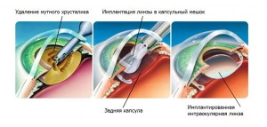 Можно ли было смотреть фильмы 3D после операции на глаза катаракты?