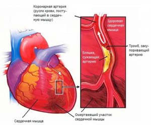 Если ли связь между инфарктом и частыми выбросами адреналина?